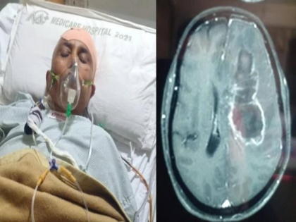 Indore: Doctors remove largest white fungus from woman's brain | Indore: Doctors remove largest white fungus from woman's brain