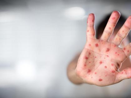 15-bed measles ward to open at Shivaji Nagar in Mumbai | 15-bed measles ward to open at Shivaji Nagar in Mumbai