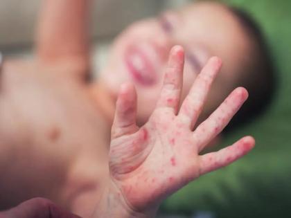 Expert team says over 500 kids with suspected measles in Mumbai | Expert team says over 500 kids with suspected measles in Mumbai