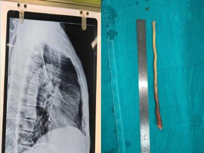 Odisha: 9-Inch Tree Twig Gets Stuck in 80-Year-Old Man’s Food Pipe for 7 Days While Brushing Teeth, Successfully Removed by Doctors | Odisha: 9-Inch Tree Twig Gets Stuck in 80-Year-Old Man’s Food Pipe for 7 Days While Brushing Teeth, Successfully Removed by Doctors Odisha: 9-Inch Tree Twig Gets Stuck in 80-Year-Old Man’s Food Pipe for 7 Days While Brushing Teeth, Successfully Removed by Doctors | Odisha: 9-Inch Tree Twig Gets Stuck in 80-Year-Old Man’s Food Pipe for 7 Days While Brushing Teeth, Successfully Removed by Doctors