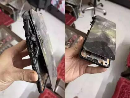 OnePlus Nord 2 phone explodes in users hand, suffers severe burns | OnePlus Nord 2 phone explodes in users hand, suffers severe burns