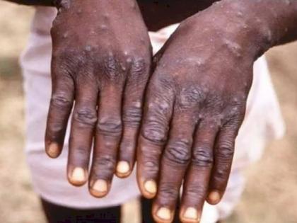 Monkeypox-infected US citizen escapes from Mexican hospital | Monkeypox-infected US citizen escapes from Mexican hospital