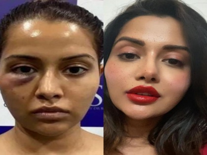 Actor Raiza Wilson's surgery goes horribly wrong, blames dermatologist for ruining her face | Actor Raiza Wilson's surgery goes horribly wrong, blames dermatologist for ruining her face