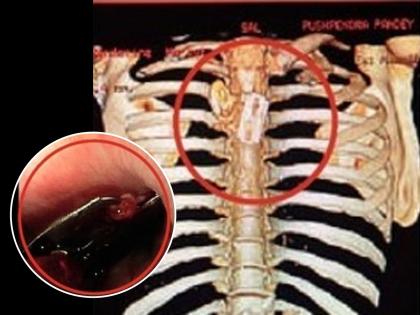 Nagpur Doctors Remove Razor Blade From 40-Year-Old Patient’s Food Pipe in Rare Surgery | Nagpur Doctors Remove Razor Blade From 40-Year-Old Patient’s Food Pipe in Rare Surgery Nagpur Doctors Remove Razor Blade From 40-Year-Old Patient’s Food Pipe in Rare Surgery | Nagpur Doctors Remove Razor Blade From 40-Year-Old Patient’s Food Pipe in Rare Surgery