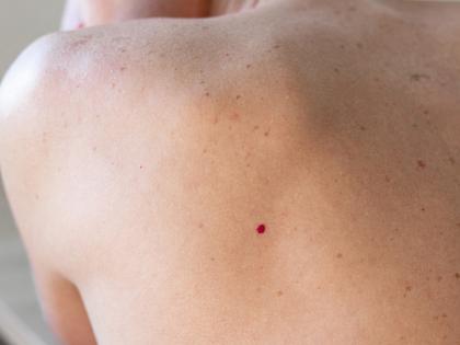 What Are Red Moles on Skin? Understanding Cherry Angiomas and Their Causes | What Are Red Moles on Skin? Understanding Cherry Angiomas and Their Causes What Are Red Moles on Skin? Understanding Cherry Angiomas and Their Causes | What Are Red Moles on Skin? Understanding Cherry Angiomas and Their Causes