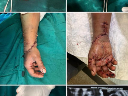 37-year-old Woman’s Hand Reattached in an 8-hour-Long Surgery | 37-year-old Woman’s Hand Reattached in an 8-hour-Long Surgery 37-year-old Woman’s Hand Reattached in an 8-hour-Long Surgery | 37-year-old Woman’s Hand Reattached in an 8-hour-Long Surgery