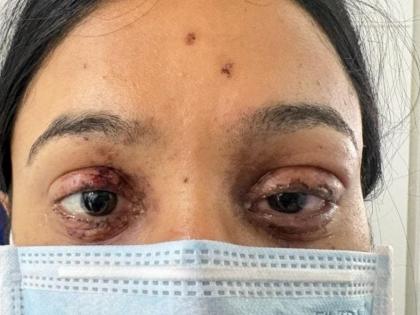 Pune Firecracker Mishap: Engineering Student Suffers Eye Burns While Celebrating Diwali | Pune Firecracker Mishap: Engineering Student Suffers Eye Burns While Celebrating Diwali Pune Firecracker Mishap: Engineering Student Suffers Eye Burns While Celebrating Diwali | Pune Firecracker Mishap: Engineering Student Suffers Eye Burns While Celebrating Diwali