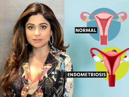 Shamita Shetty Diagnosed with Endometriosis: All You Need to Know About the Medical Condition | Shamita Shetty Diagnosed with Endometriosis: All You Need to Know About the Medical Condition