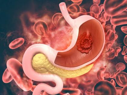 Can Persistent Acidity and Heartburn Be a Sign of Gastric Cancer? | Can Persistent Acidity and Heartburn Be a Sign of Gastric Cancer? Can Persistent Acidity and Heartburn Be a Sign of Gastric Cancer? | Can Persistent Acidity and Heartburn Be a Sign of Gastric Cancer?