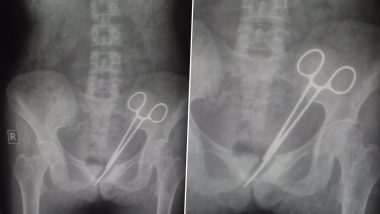 Madhya Pradesh Shocker: Woman Discovers Surgical Scissors Left Inside Her Body Two Years After Cancer Treatment | Madhya Pradesh Shocker: Woman Discovers Surgical Scissors Left Inside Her Body Two Years After Cancer Treatment Madhya Pradesh Shocker: Woman Discovers Surgical Scissors Left Inside Her Body Two Years After Cancer Treatment | Madhya Pradesh Shocker: Woman Discovers Surgical Scissors Left Inside Her Body Two Years After Cancer Treatment