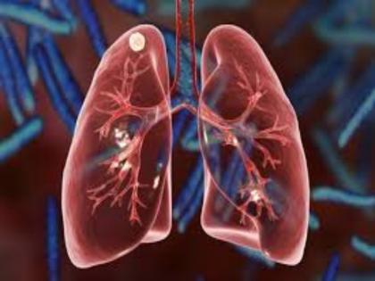 World Tuberculosis Day: Lesser known facts about tuberculosis