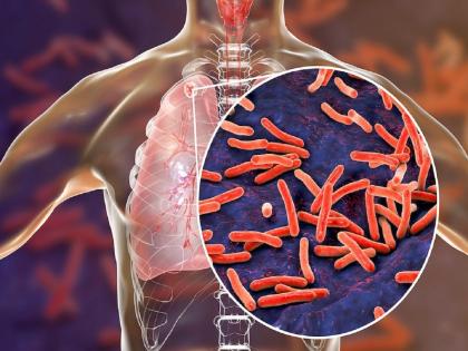 Mizoram Faces Rise in in Tuberculosis; 108 Succumbed to Disease in 2023 | Mizoram Faces Rise in in Tuberculosis; 108 Succumbed to Disease in 2023