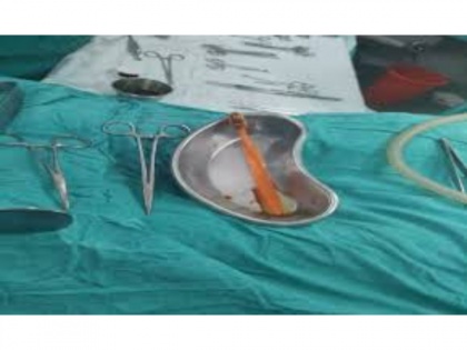 33 year-old man swallows 'toothbrush', Maha docs perform life-saving surgery | 33 year-old man swallows 'toothbrush', Maha docs perform life-saving surgery