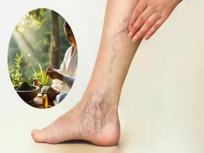Varicose Veins Pain Relief: How Potli Massage Can Help Soothe Leg Veins Naturally | Varicose Veins Pain Relief: How Potli Massage Can Help Soothe Leg Veins Naturally