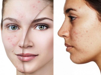 What is cystic acne? Check out the home remedies to reduce Cystic Acne | What is cystic acne? Check out the home remedies to reduce Cystic Acne