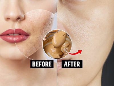 Summer Skincare Solutions: Home Remedies for Oily Skin and Glow-Boosting Tips
