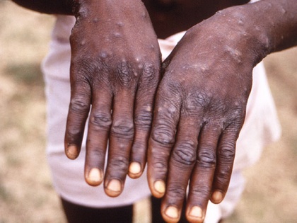 U.S reports first case of rare human Monkeypox | U.S reports first case of rare human Monkeypox