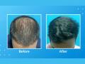 Vcare’s Treatment For Hair Loss And Hair Thinning - Hindi News | Vcare’s Treatment For Hair Loss And Hair Thinning | Latest business News at Lokmattimes.com