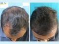 VCare’s Hair Transplantation Ensures To Completely Reverse Baldness - Hindi News | VCare’s Hair Transplantation Ensures To Completely Reverse Baldness | Latest business News at Lokmattimes.com