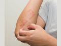 The impact of stress on Psoriasis - Hindi News | The impact of stress on Psoriasis | Latest health News at Lokmattimes.com