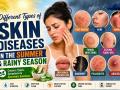 Different types of skin diseases in the Summer and Rainy Season - Hindi News | Different types of skin diseases in the Summer and Rainy Season | Latest business News at Lokmattimes.com