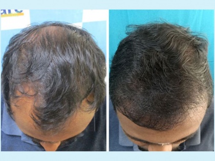 VCare’s Hair Transplantation Ensures To Completely Reverse Baldness | VCare’s Hair Transplantation Ensures To Completely Reverse Baldness