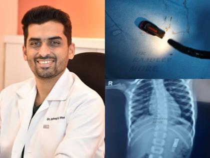 A Pen Drive Accidentally Swallowed By A 5-Year-Old Boy Removed Endoscopically, thereby avoiding major surgery | A Pen Drive Accidentally Swallowed By A 5-Year-Old Boy Removed Endoscopically, thereby avoiding major surgery
