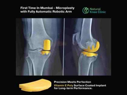 Medical Breakthrough: Preserve Your Natural Knee with Absolute Precision Robotic Microplasty Surgical Technique | Medical Breakthrough: Preserve Your Natural Knee with Absolute Precision Robotic Microplasty Surgical Technique Medical Breakthrough: Preserve Your Natural Knee with Absolute Precision Robotic Microplasty Surgical Technique | Medical Breakthrough: Preserve Your Natural Knee with Absolute Precision Robotic Microplasty Surgical Technique