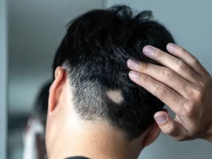Alopecia Areata Homeopathy Treatment Offers Hope for Adults and Adolescents | Alopecia Areata Homeopathy Treatment Offers Hope for Adults and Adolescents Alopecia Areata Homeopathy Treatment Offers Hope for Adults and Adolescents | Alopecia Areata Homeopathy Treatment Offers Hope for Adults and Adolescents