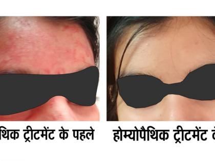 Rare disease Blood-Sweating Disorder Successfully Treated with Advanced Homeopathy – Dr AK dwivedi | Rare disease Blood-Sweating Disorder Successfully Treated with Advanced Homeopathy – Dr AK dwivedi Rare disease Blood-Sweating Disorder Successfully Treated with Advanced Homeopathy – Dr AK dwivedi | Rare disease Blood-Sweating Disorder Successfully Treated with Advanced Homeopathy – Dr AK dwivedi