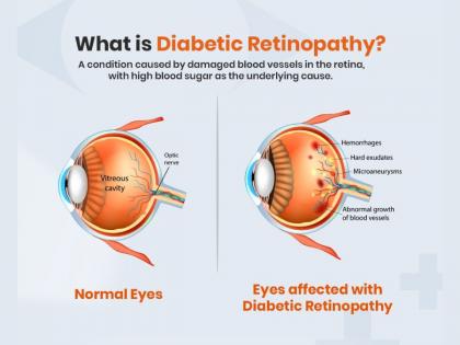 Can Diabetic Retinopathy Be Reversed? | Can Diabetic Retinopathy Be Reversed? Can Diabetic Retinopathy Be Reversed? | Can Diabetic Retinopathy Be Reversed?