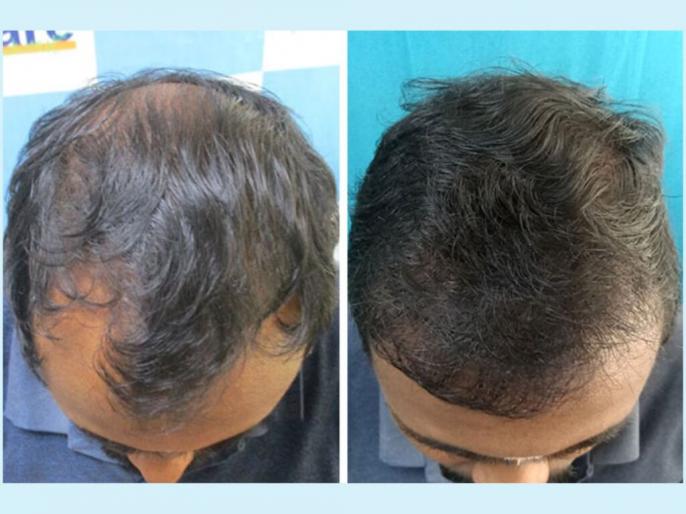 VCare’s Hair Transplantation Ensures To Completely Reverse Baldness ...