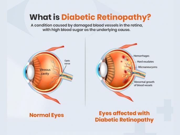 can-diabetic-retinopathy-be-reversed-www-lokmattimes