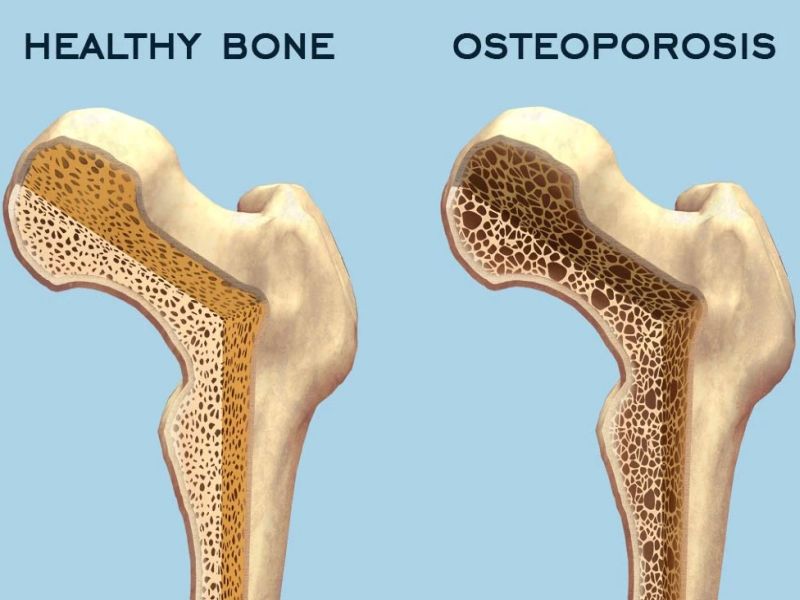 Calcium: कैल्शियम के कमी के होते हैं यह लक्षण, शरीर के लिए बेहद जरूरी.. 30 Osteoporosis: जानिये हड्डियों की बीमारी ऑस्टियोपोरोसिस के 3 गंभीर लक्षण, किसे है ज्यादा खतरा, बचाव और डाइट प्लान