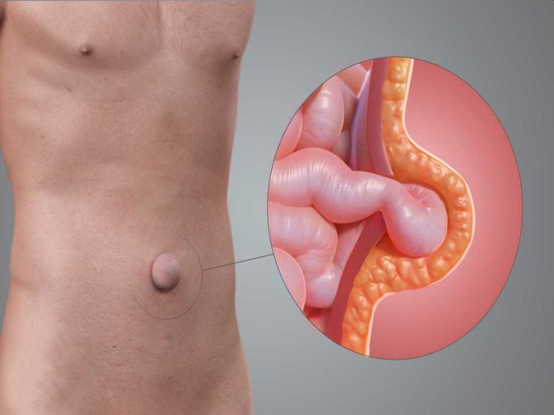 पेट की गांठ का इलाज : पेट में गांठ abdominal lump के 10 लक्षण, जानें क्यों  बनती है पेट में गांठ और इलाज
