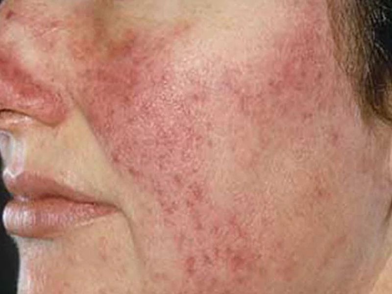 त वच र ग र ज श य क इल ज चर म र ग Rosacea क 4 लक षण समझ र हत प न क ल ए आजम ए 5 घर ल उप य