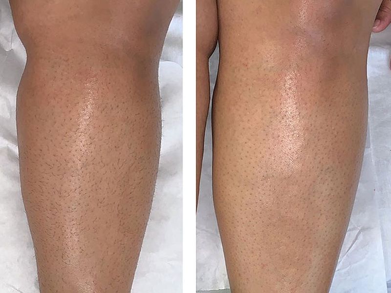 Strawberry Legs treatment: पैरों पर बालों की जड़ो में दिखने वाले बड़े छिद्रों और काले धब्बों से इन 3 आसान तरीकों से पाएं छुटकारा