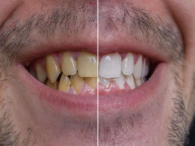 पीले दांतों को सफेद कैसे करें : दांतों को कालापन-पीलापन दूर करने, मुंह की  बदबू हटाने के लिए अपनाएं ये 6 घरेलू तरीके