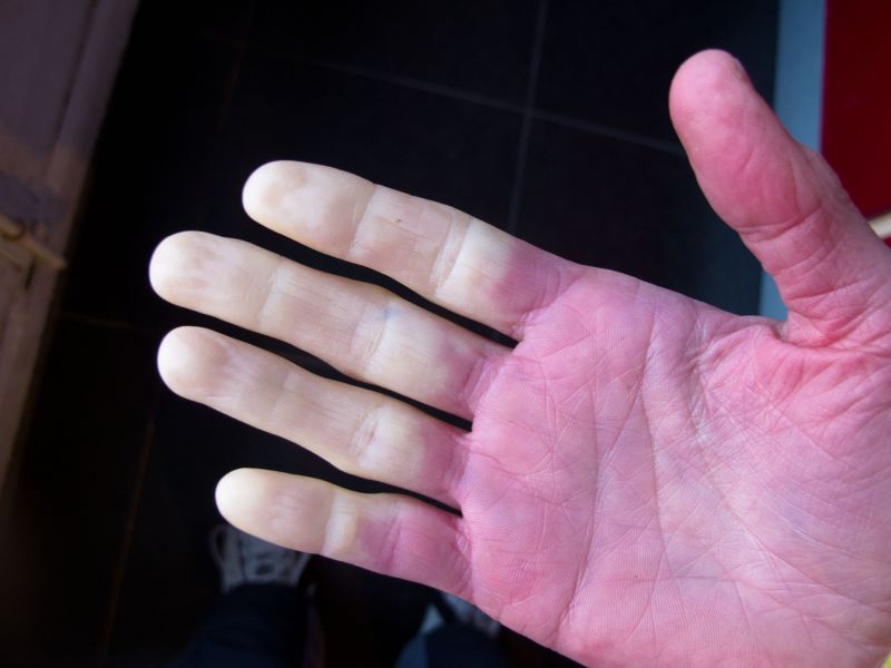 सावधान! सर्दियों में कहीं आपके हाथ-पैरों का रंग तो नहीं बदल रहा? इस गंभीर  बीमारी के हैं लक्षण