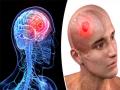 ब्रेन स्ट्रोक के शुरुआती लक्षण, जरा से लापरवाही से जा सकती है मरीज की जान - Hindi News | Brain Stroke Symptoms Signs Causes Diagnosis and Treatment | Latest health Photos at Lokmatnews.in