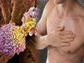 Breast Cancer in men: पुरुषों में ब्रेस्ट कैंसर के 5 लक्षण, जानिये कारण और किसे है ज्यादा खतरा - Hindi News | Breast Cancer in men: breast cancer symptoms in men, cause, medical treatment and prevention tips in Hindi | Latest health News at Lokmatnews.in
