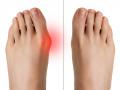 Bunion pain relief home remedies: पैर के अंगूठे और पंजों के दर्द के लिए 6 असरदार घरेलू उपाय - Hindi News | Bunion pain relief home remedies: 8 best and effective ways to ease Bunion Pain Naturally | Latest health News at Lokmatnews.in