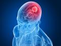 ब्रेन कैंसर से पहले शरीर देता है ये 6 संकेत, जानें क्या हैं लक्षण - Hindi News | 6 signs before brain cancer, Identify the Symptoms‎ Cancer Signs And Symptoms | Latest health Photos at Lokmatnews.in