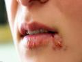 सर्दियों में होंठों के पास होने वाले दर्दनाक घावों को 1 दिन में साफ कर देंगी ये 5 चीजें - Hindi News | cold sore and mouth ulcer : treatment, home remedies, causes and symptoms | Latest health News at Lokmatnews.in