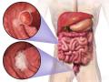 Colorectal Cancer Awareness Month: आंत का कैंसर होने से पहले शरीर देता है 10 संकेत, समझें और बचाव करें - Hindi News | early sign and symptoms of Colorectal Cancer in Hindi: causes, prevention tips and medical treatment of Colorectal Cancer in Hindi | Latest health News at Lokmatnews.in