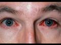 रंजना मिश्रा ब्लॉग: तेजी से फैलते आई फ्लू से कैसे बचें? - Hindi News | conjunctivitis How to avoid fast spreading eye flu? | Latest health News at Lokmatnews.in