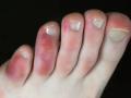 COVID-19 symptoms in the feet: पैरों में दिख सकते हैं कोरोना के 3 लक्षण, समझें और जांच कराएं - Hindi News | COVID-19 symptoms in the feet: 3 severs symptoms of coronavirus you can find in the feet | Latest health News at Lokmatnews.in