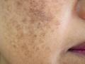 how to remove dark spots: चेहरे के काले धब्बों से छुटकारा पाने के लिए आजमाएं ये 6 असरदार घरेलू उपाय - Hindi News | how to remove dark spots: try these 6 best and effective home remedies to treat Dark Spots On Face | Latest health News at Lokmatnews.in