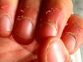 how to get rid hangnail: नाखूनों के पास खाल छिलने और दर्द से छुटकारा पाने के 6 असरदार उपाय - Hindi News | how to get rid hangnail: sign and symptoms of hangnail, home remedies and treatment of hangnail in Hindi | Latest health News at Lokmatnews.in