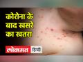 खसरे का एक मरीज 18 अन्य लोगों को कर सकता है संक्रमित, लगातार फैल रही बिमारी - Hindi News | Measles patient can infect 18 other people, disease spreading continuously | Latest india Videos at Lokmatnews.in